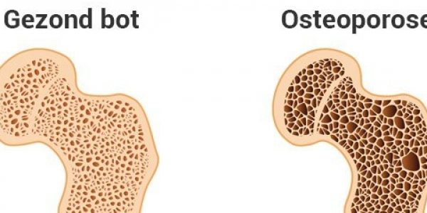 Artrose of Osteoporose Artrose of Osteoporose